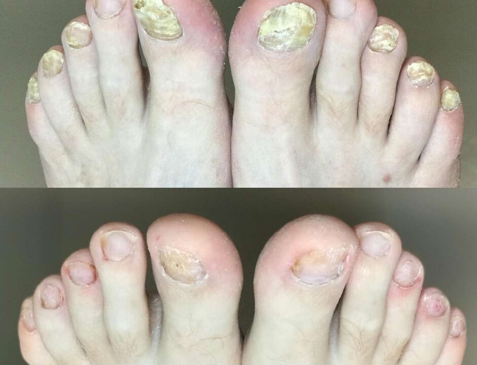 Before and after treatment, the Promol of the Mushroom cream