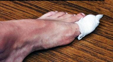 Compresses for the treatment of the mushroom on the thumb of the leg