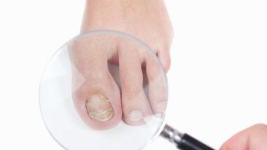 How to treat a mushroom on the thumb of the leg