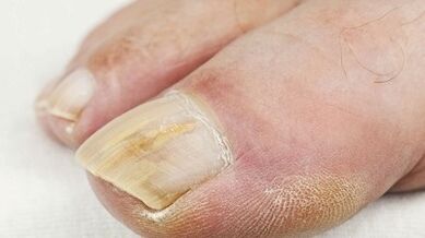 The reasons for the appearance of the mushroom on the thumb of the leg