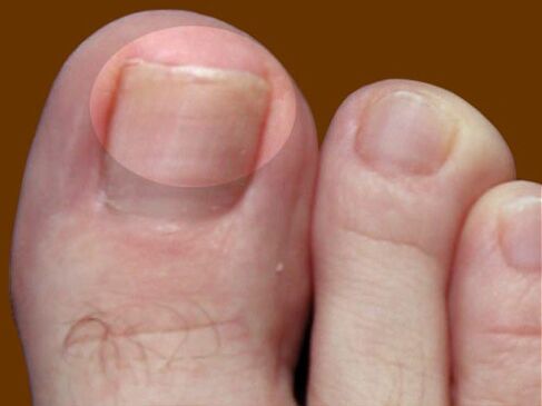 The first signs of nail fungus