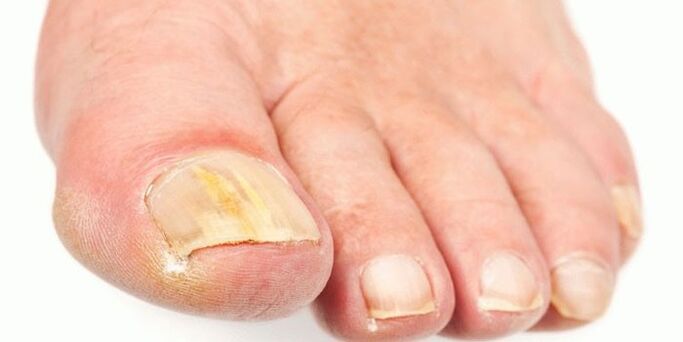 Effective products from the nail fungus