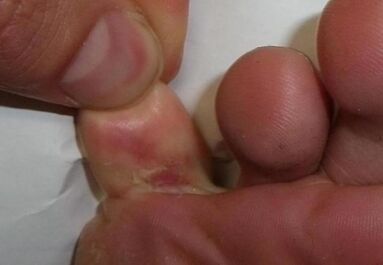 broken toe due to fungal infection