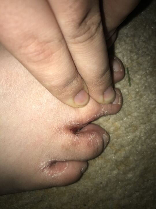 fungal infection of toes