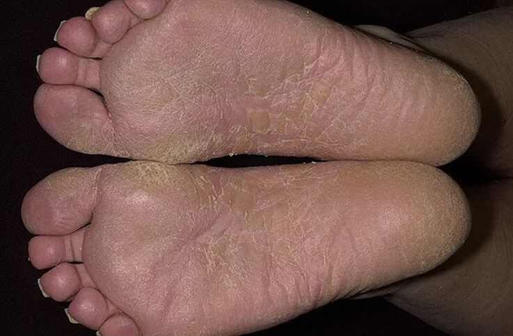 Dry, scaly skin on the feet is a sign of scaly mycosis