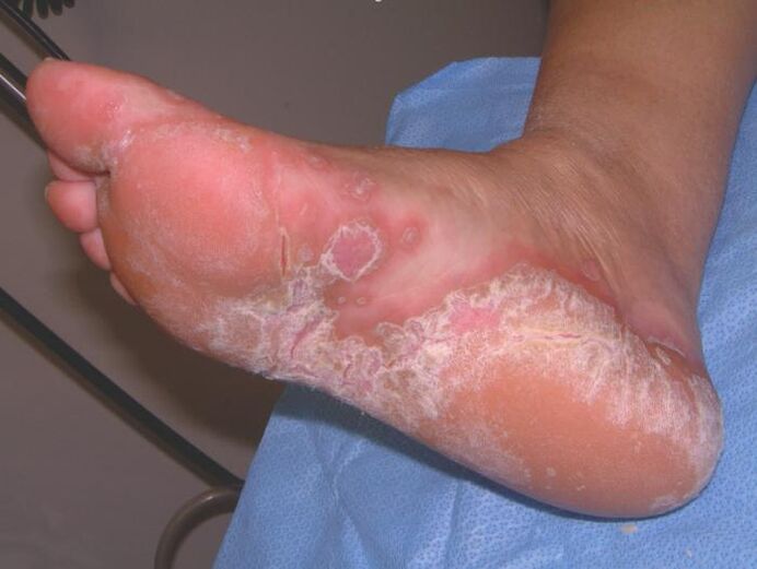 Foot affected by fungal infection